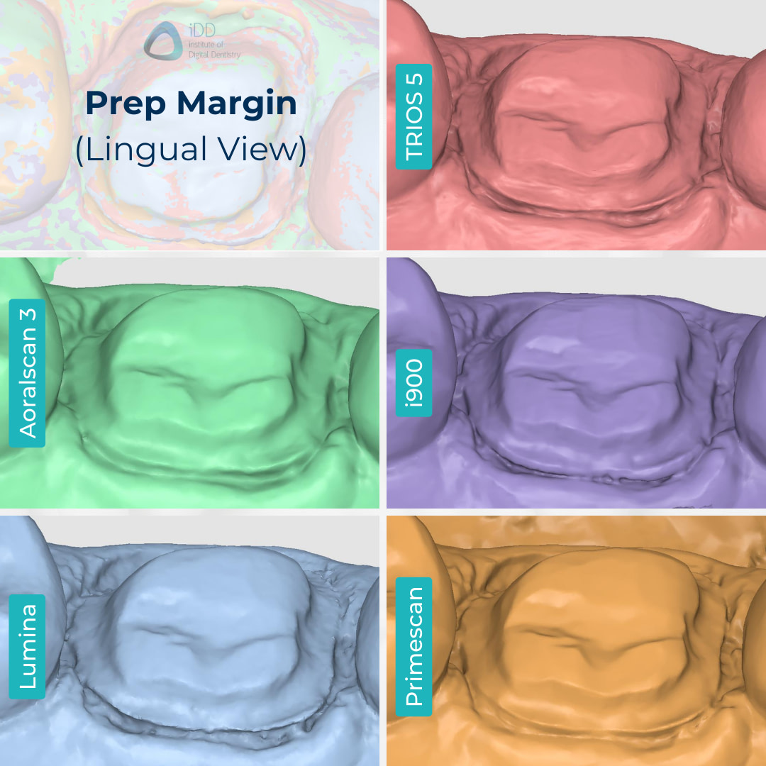 medit-i900-itero-lumina-cerec-primescan-3shape-trios-5-shining-3d-aoralscan-3-intraoral-scanner-idd-compares-institute-of-digital-dentistry-medit-design-prep-margin-lingual-view-scan