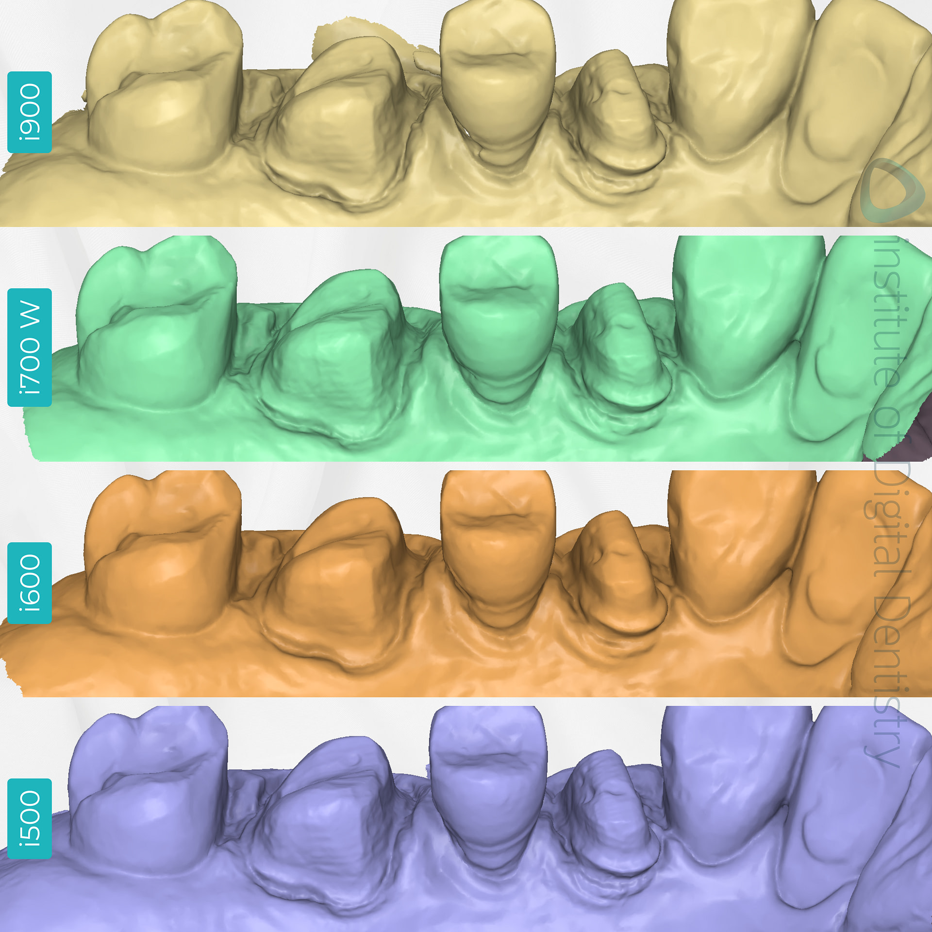medit-intraoral-scanner-i500-i600-i700-wireless-i900-idd-compares-institute-of-digital-dentistry-blog-prep-margin-line-lingual-view