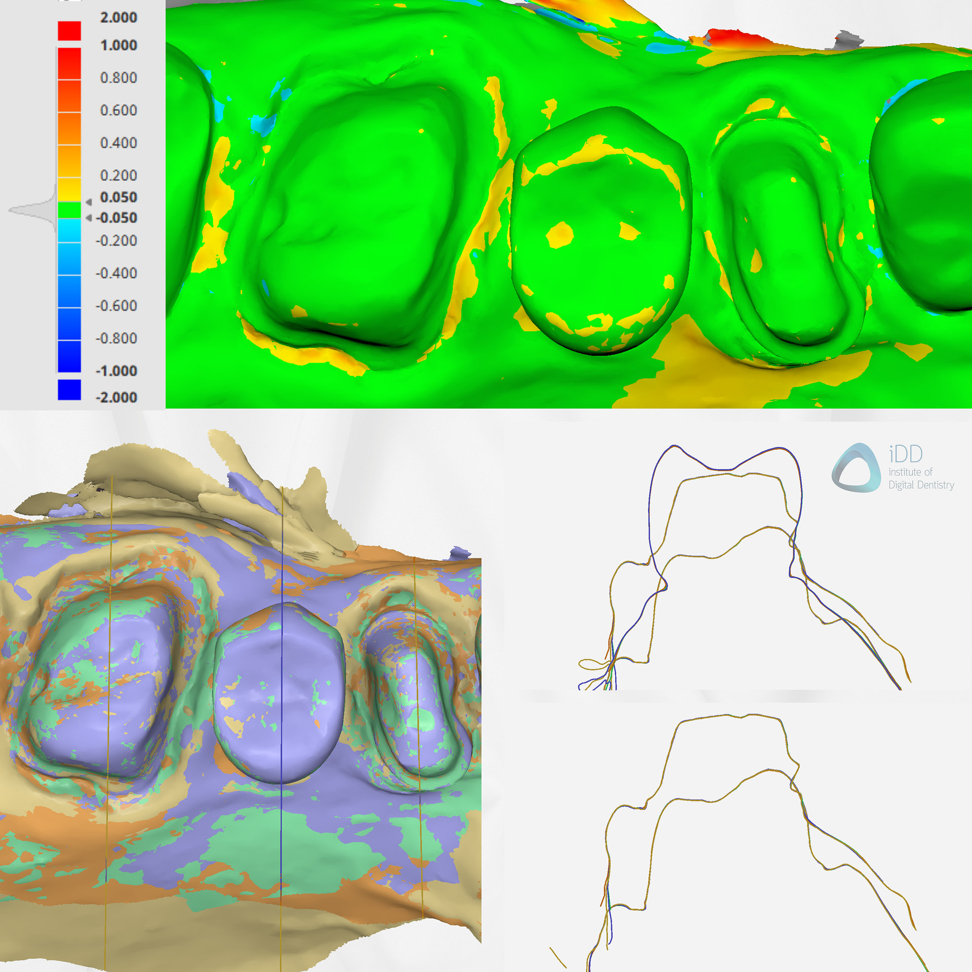 medit-intraoral-scanner-i500-i600-i700-wireless-i900-idd-compares-institute-of-digital-dentistry-blog-deviation-alignment-scans