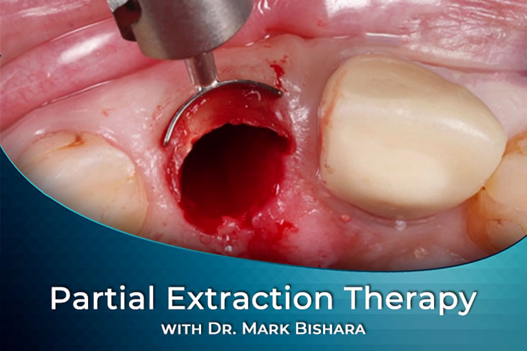 Partial-Extraction-Therapy-online-course-spiffy