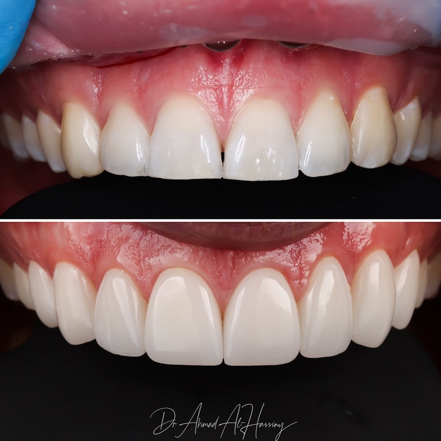 exocad course design