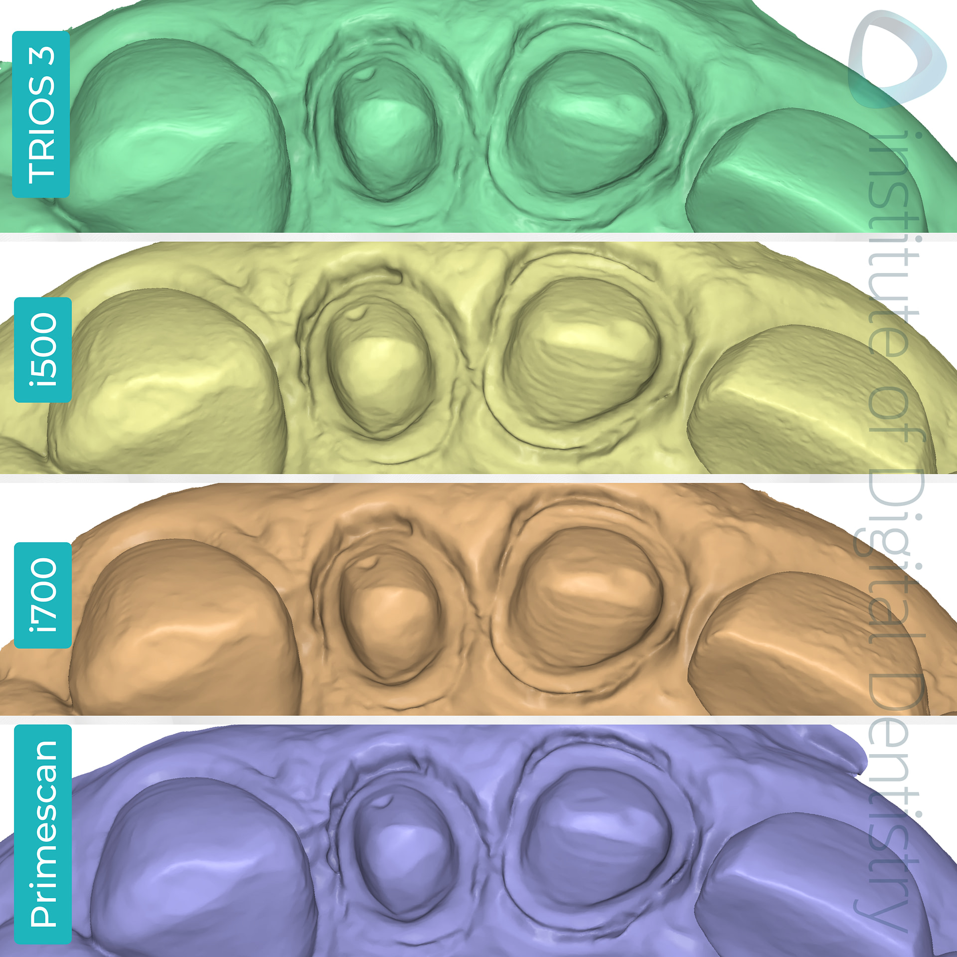 idd-compares-intraoral-scanners-3shape-trios3-medit-i500-i700-dentsply-sirona-cerec-primescan-medit-design-software-app-incisal-view-margin-prep.png