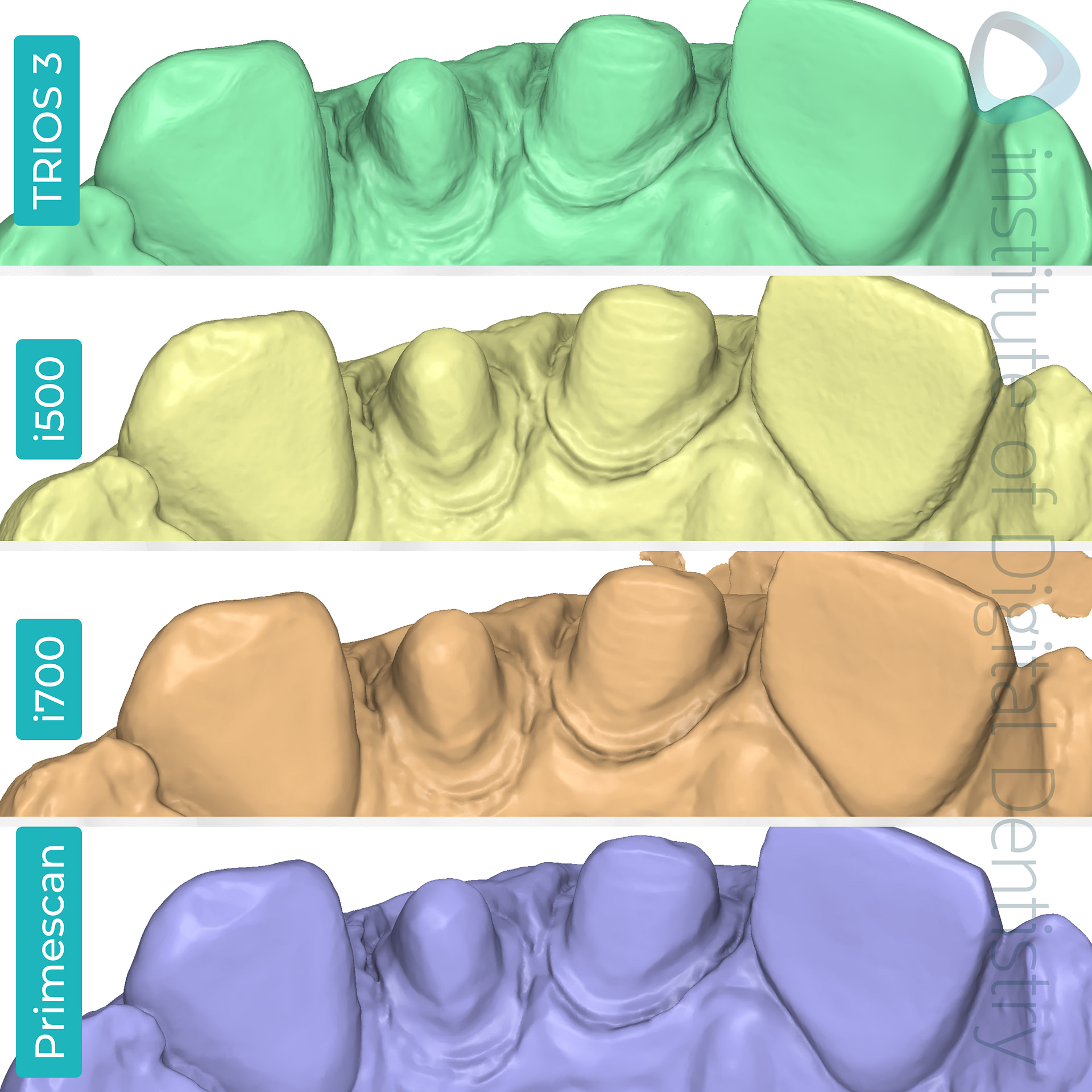 idd-compares-intraoral-scanners-3shape-trios3-medit-i500-i700-dentsply-sirona-cerec-primescan-medit-design-software-app-palatal-view-margin-prep