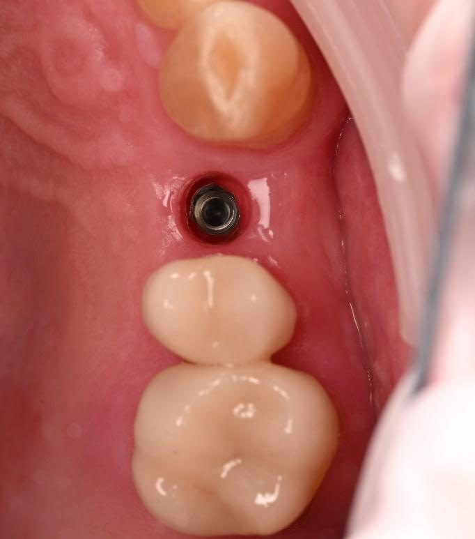 3 months after implant placement. An excellent volume of buccal contour
