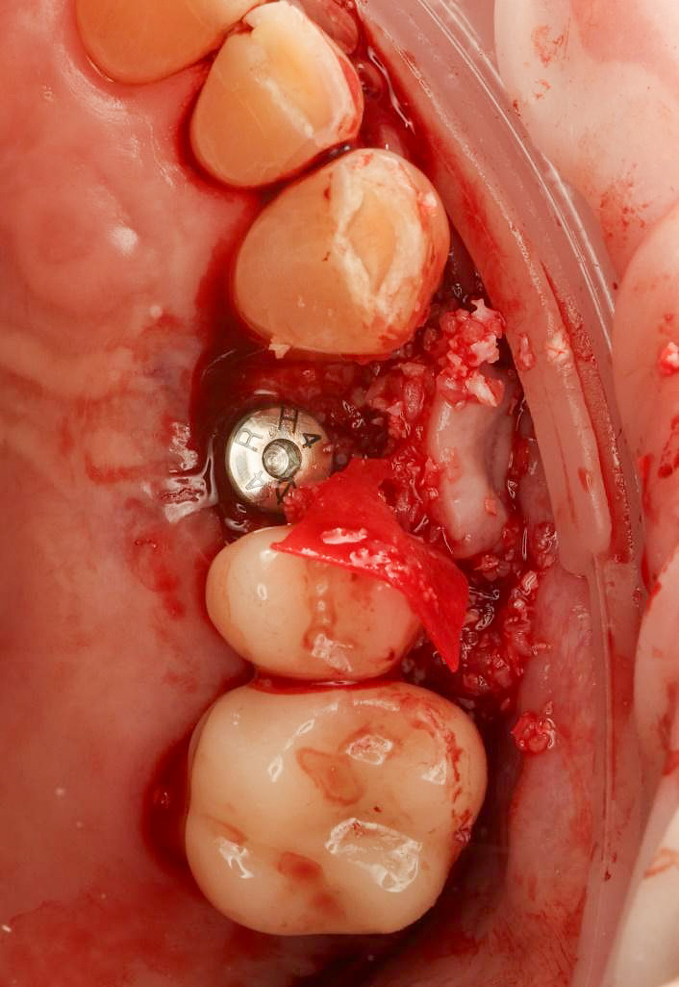 A 50-50 mix of xenograft_allograft particulate bone graft was used to augment the buccal defect