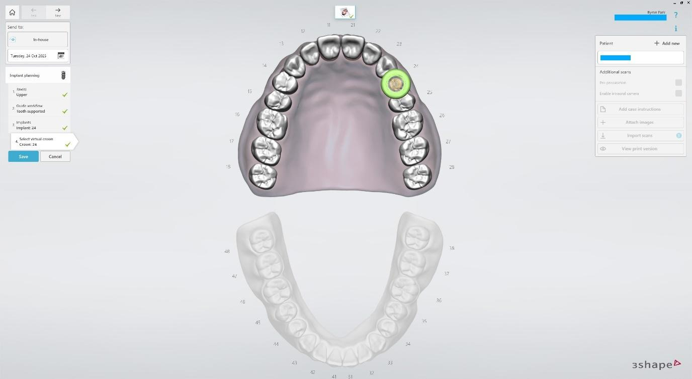 Create a New Case in Implant Studio