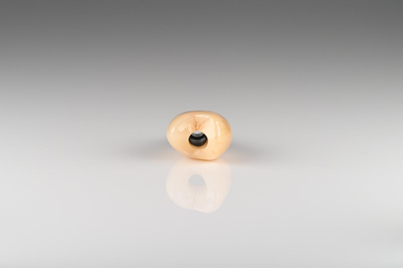 Crown is milled, sintered, stained, glazed, and cemented to the Ti base 4