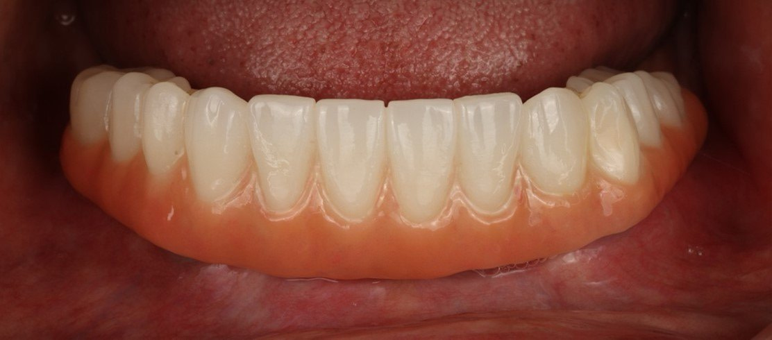 Fig.11+Final+Prosthesis+Lower+Zirconia+Insert