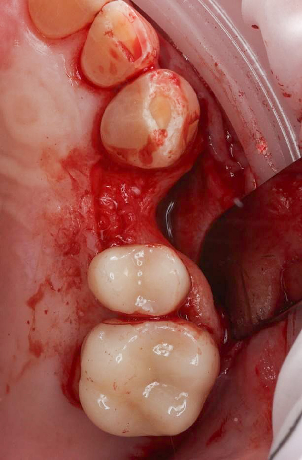 Implant surgery under local anaesthetic