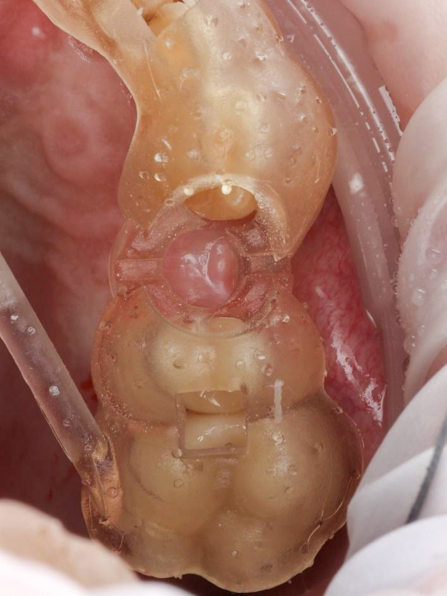 Implant surgery was done under local anaesthetic