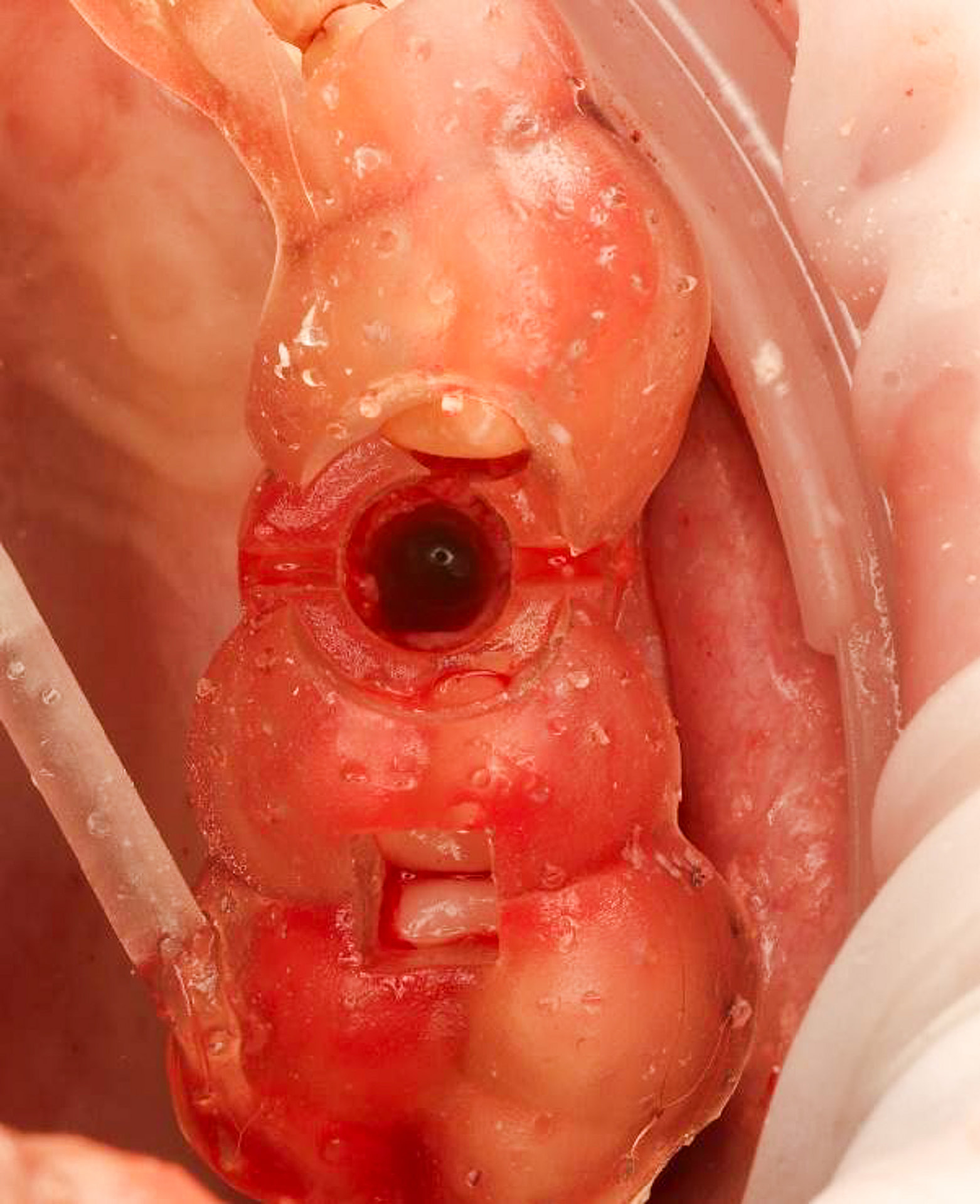 The Osstem OneGuide kit is used with a fully guided osteotomy and implant placement