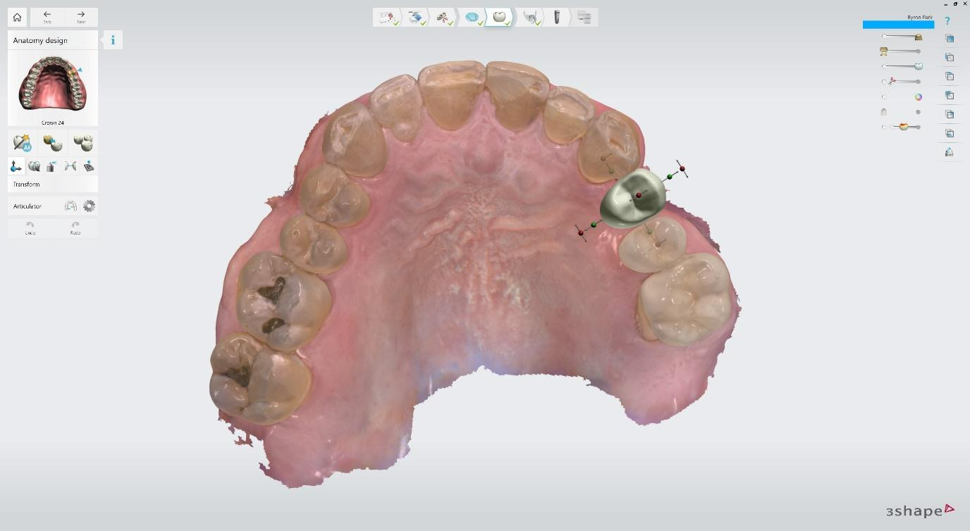 Virtual crown design before implant planning 2