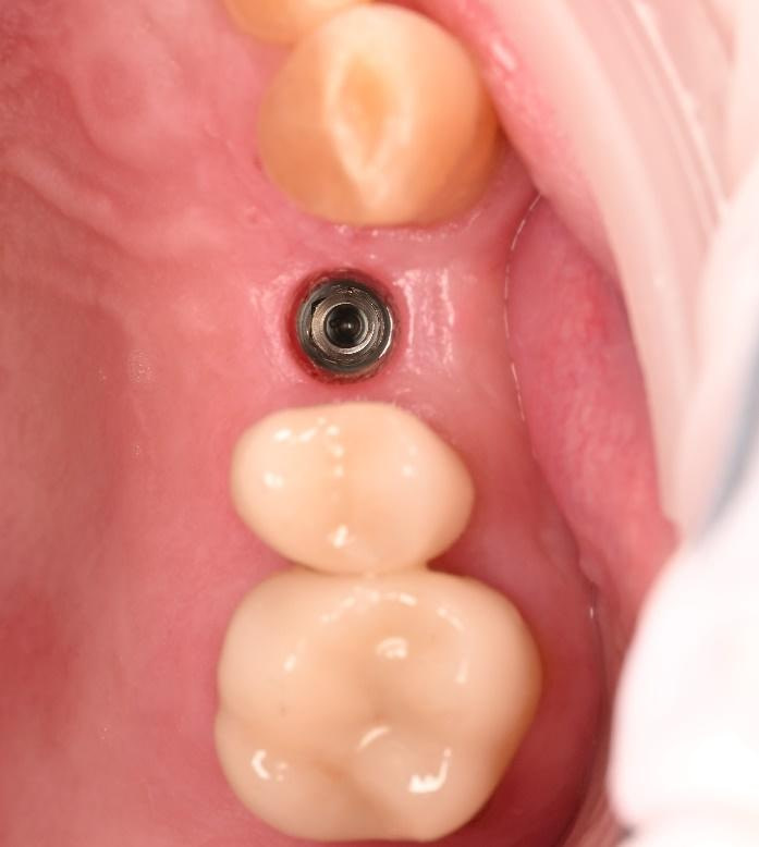dental implant restoration 2