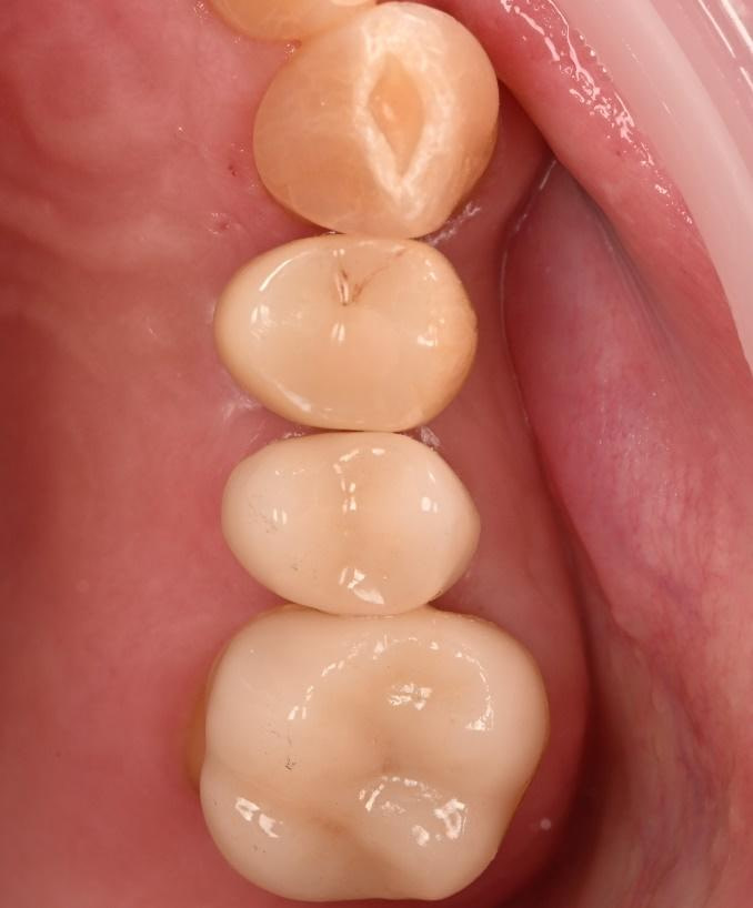 dental implant restoration 4