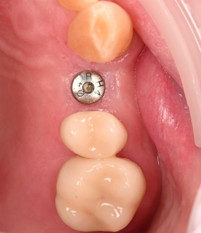 dental implant restoration