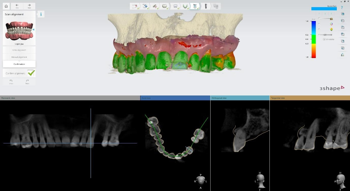 implant CBCT alignment