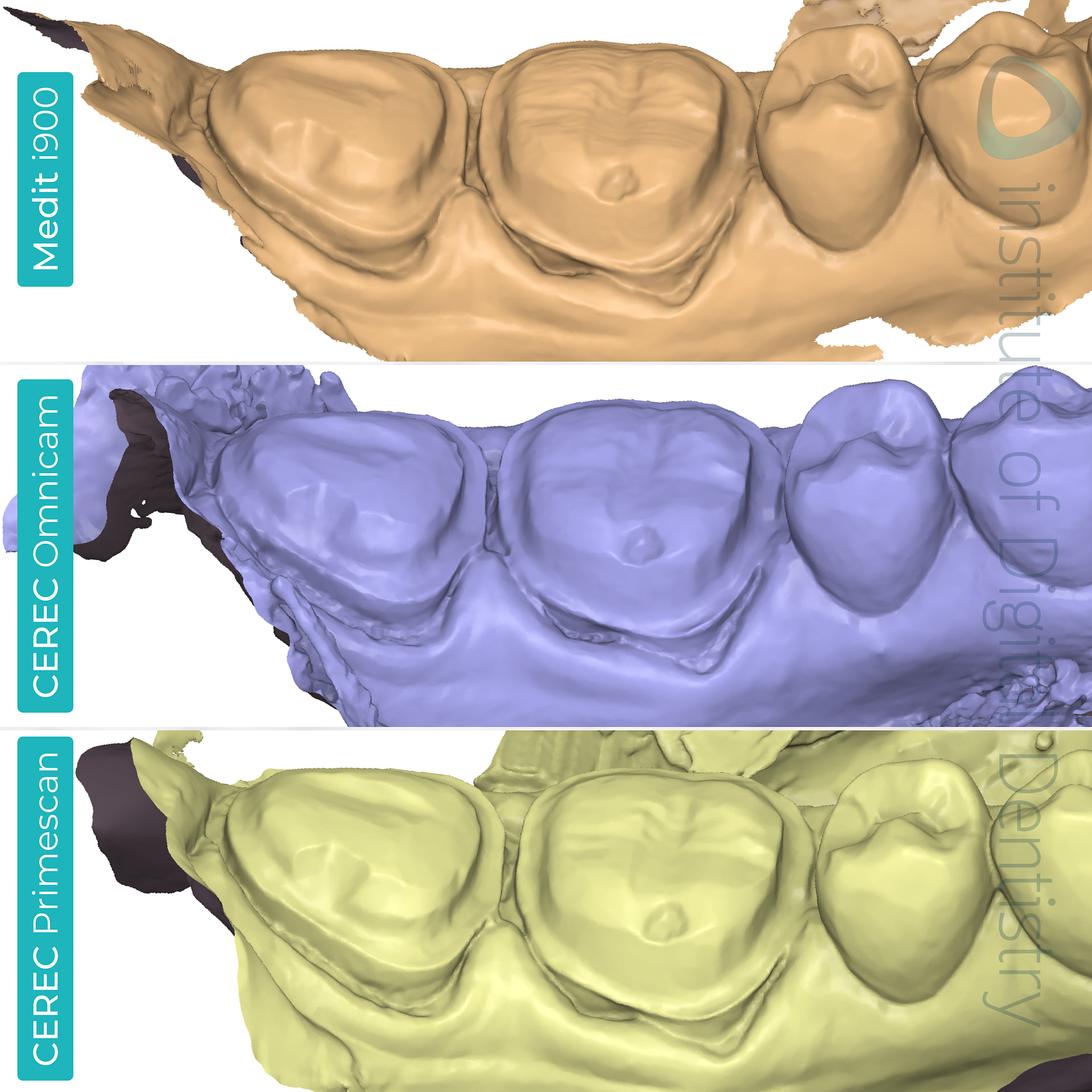 medit-i900-cerec-omnicam-cerec-primescan-dentsply-sirona-idd-compares-institute-of-digital-dentistry-blog-medit-design-software-app-prep-margin-line-buccal-view