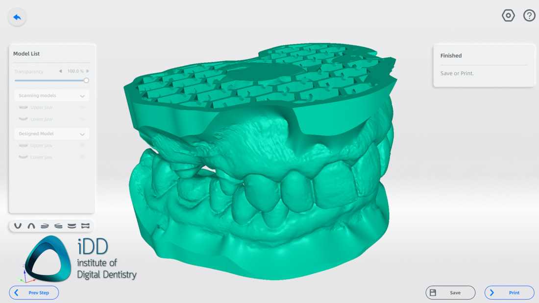 shining_3d_aoralscan_3_software_splint_model_builder_ortho (4)