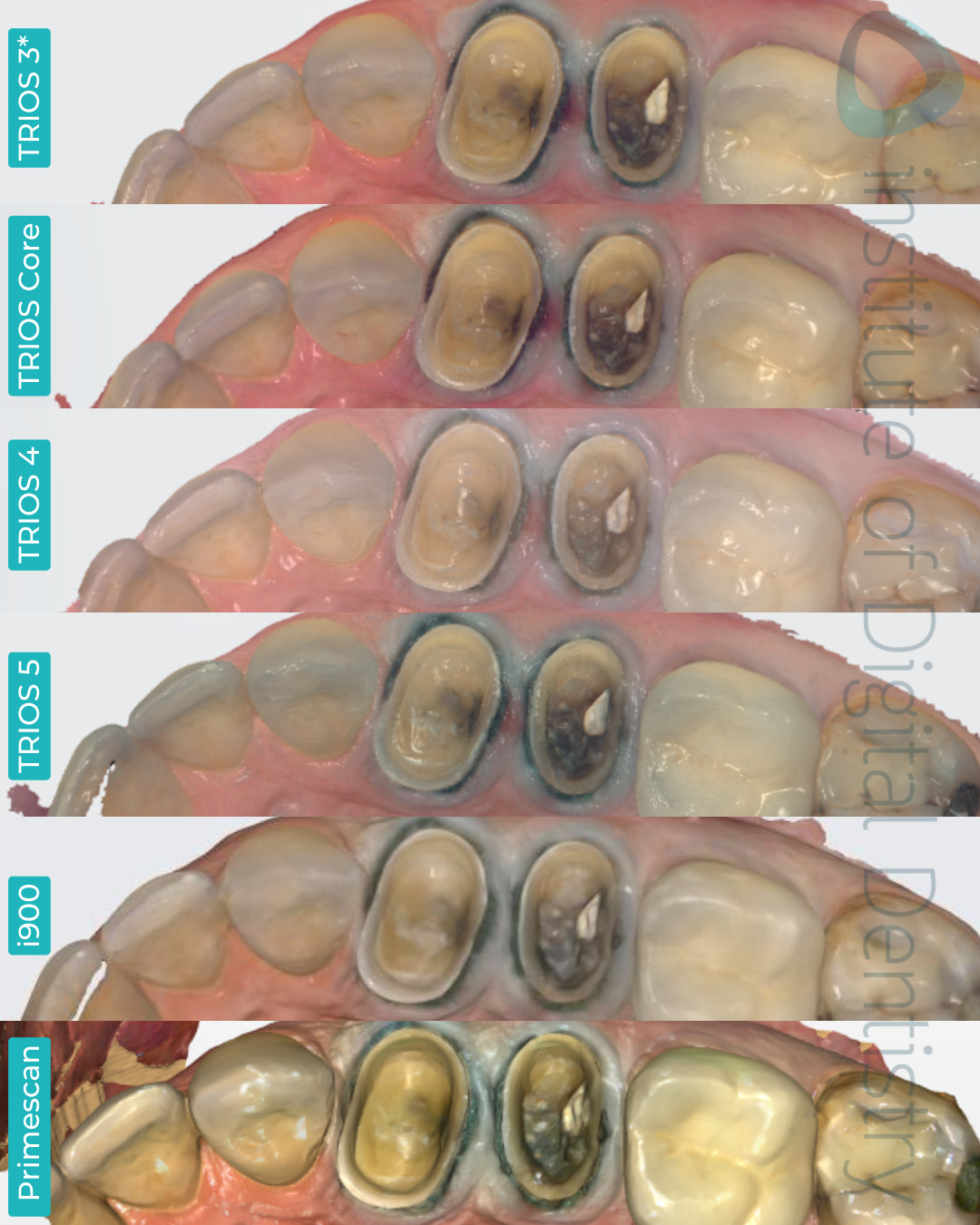 3shape-trios-3-updated-4-5-core-medit-i900-dentsply-sirona-cerec-primescan-intraoral-scanner-institute-of-digital-dentistry-idd-compares-blog-native-software-processed-color-scans
