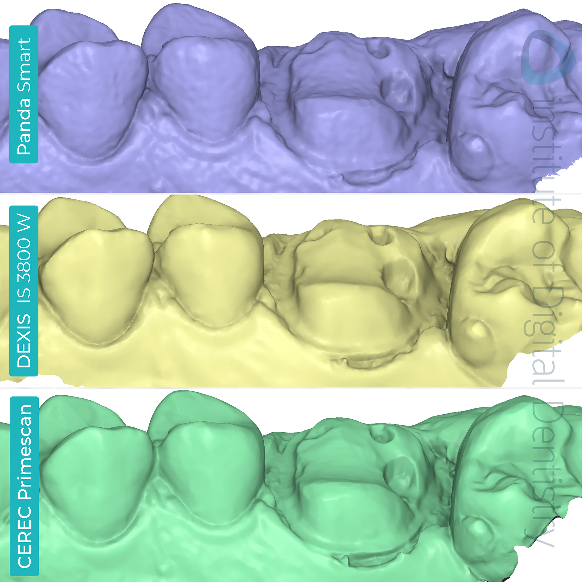 panda-smart-dexis-is-3800-w-cerec-primescan-dentsply-sirona-medit-design-software-stl-file-scan-prep-margin-line-buccal-view-idd-compares-institute-of-digital-dentistry-blog