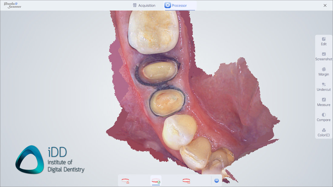 panda_smart_IOS_review_intraoral_scanner_institute_of_digital_dentistry (5)