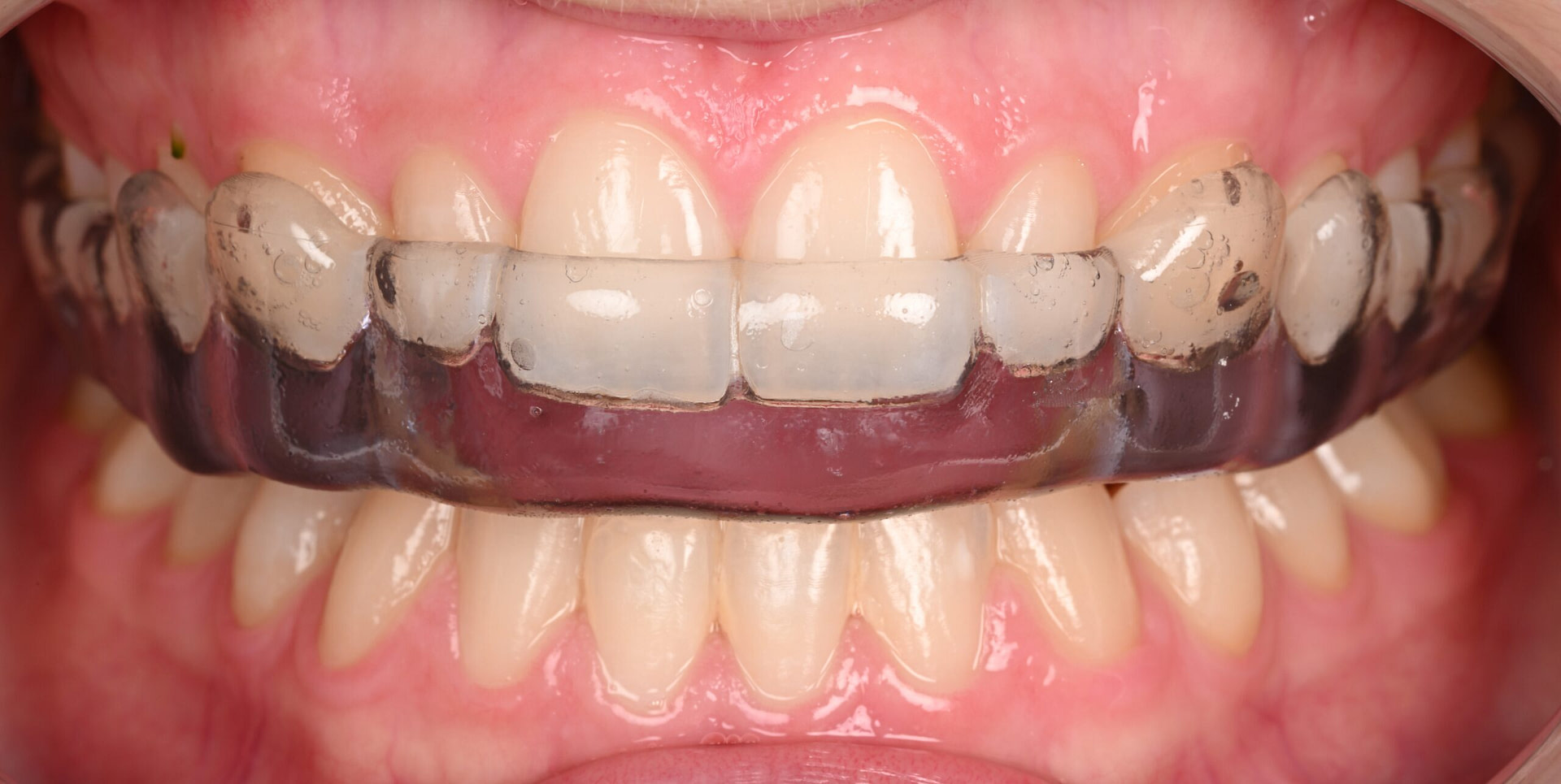 3shape-intraoral-trios-scan-bite-splint-idd-institute-of-digital-dentistry-blog-byron-park-final-splint-try-in-bite