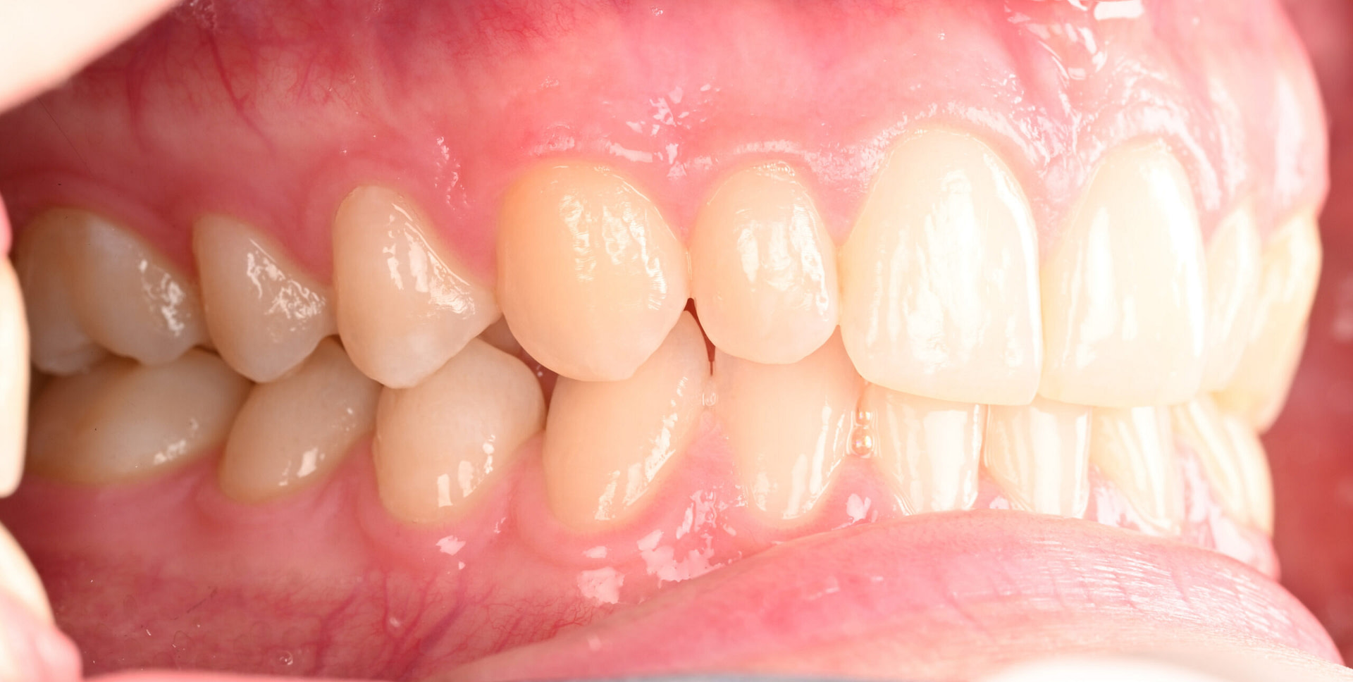 3shape-intraoral-trios-scan-bite-splint-idd-institute-of-digital-dentistry-blog-byron-park-patient-buccal-bite-view-quadrant-1-4