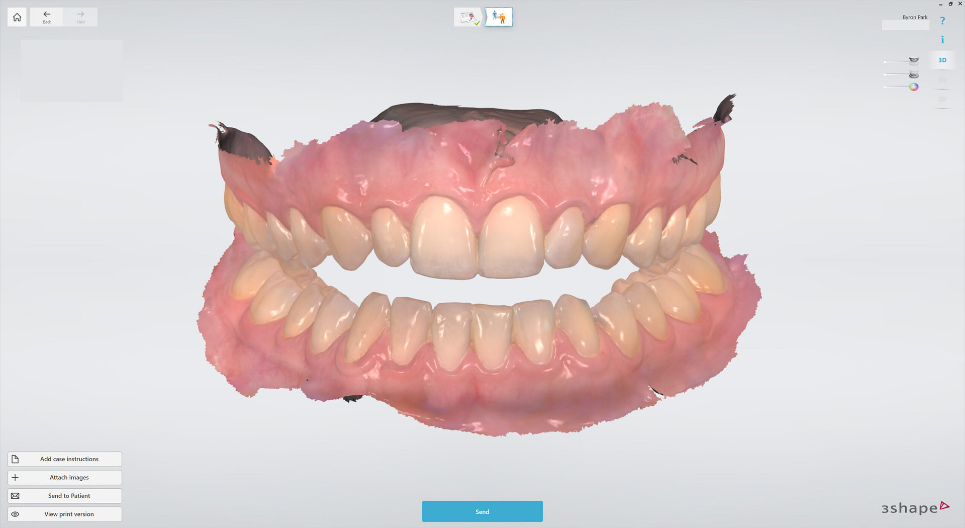 3shape-intraoral-trios-scan-bite-splint-idd-institute-of-digital-dentistry-blog-byron-park-patient-intraoral-scan-open-bite
