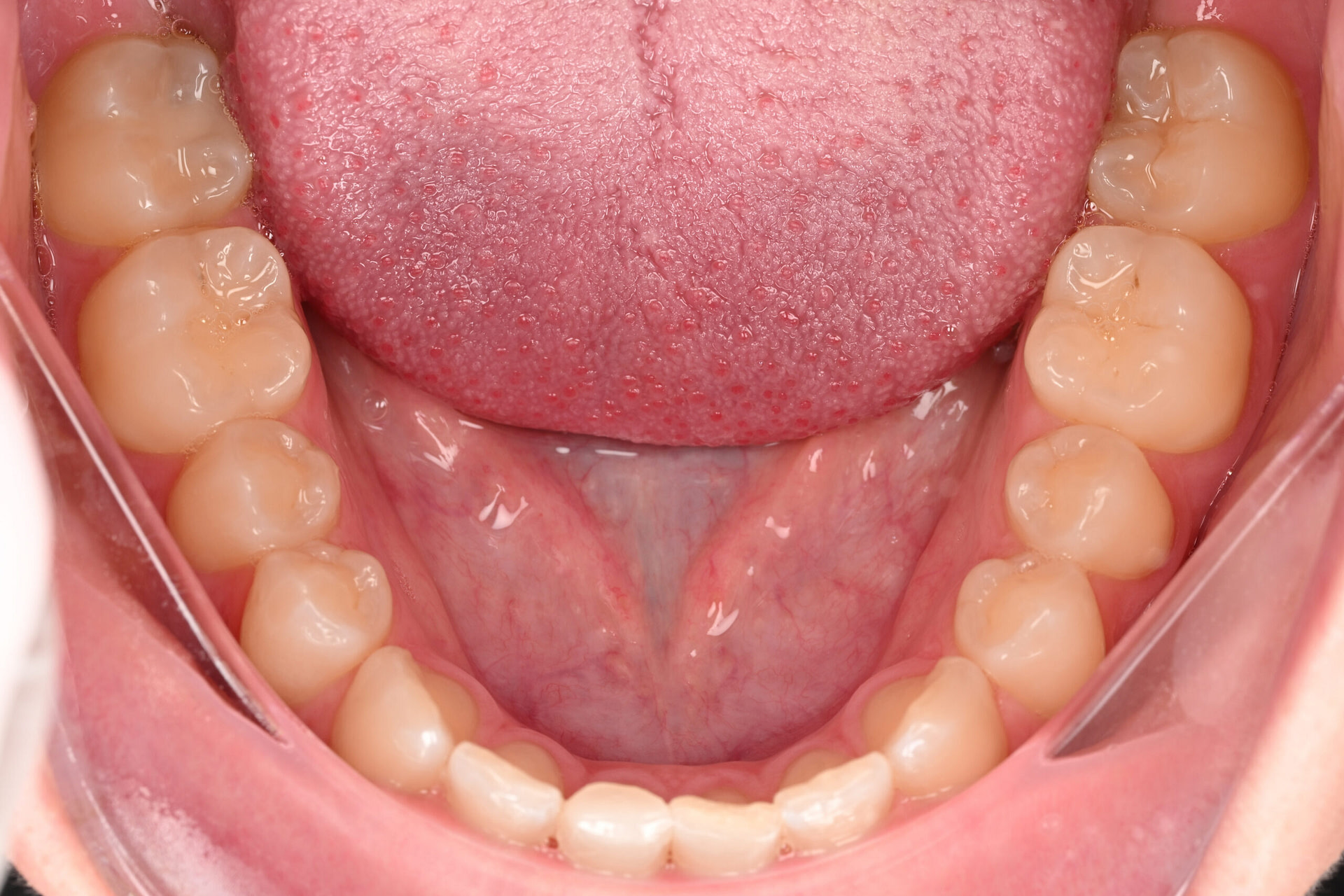 3shape-intraoral-trios-scan-bite-splint-idd-institute-of-digital-dentistry-blog-byron-park-patient-lingual-view