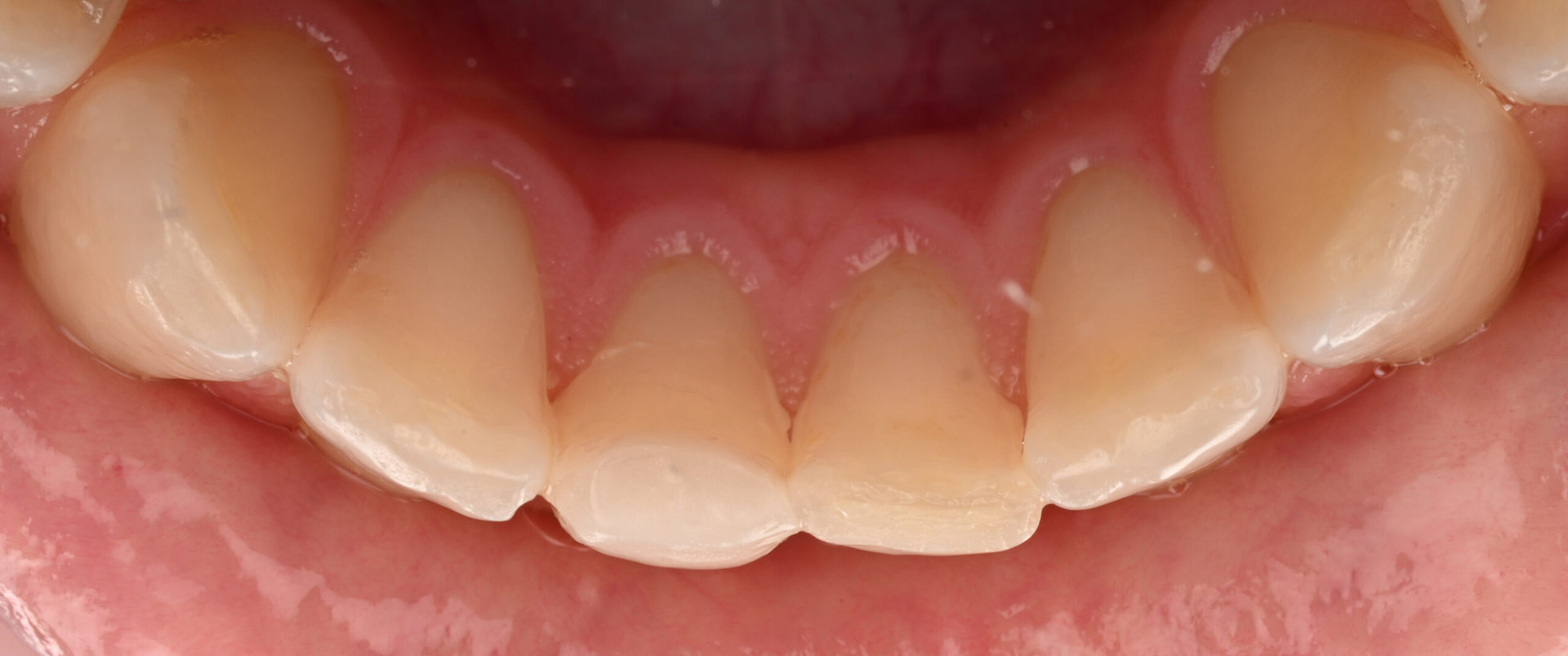 3shape-intraoral-trios-scan-bite-splint-idd-institute-of-digital-dentistry-blog-byron-park-patient-lingual-zoom-incisors