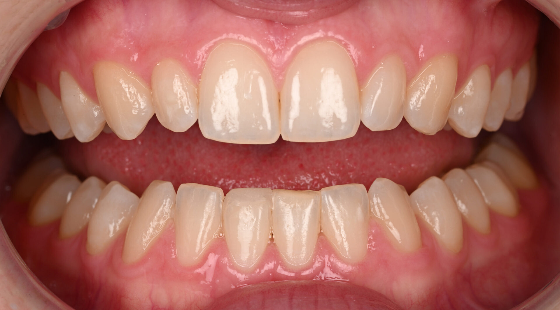 3shape-intraoral-trios-scan-bite-splint-idd-institute-of-digital-dentistry-blog-byron-park-patient-open-bite