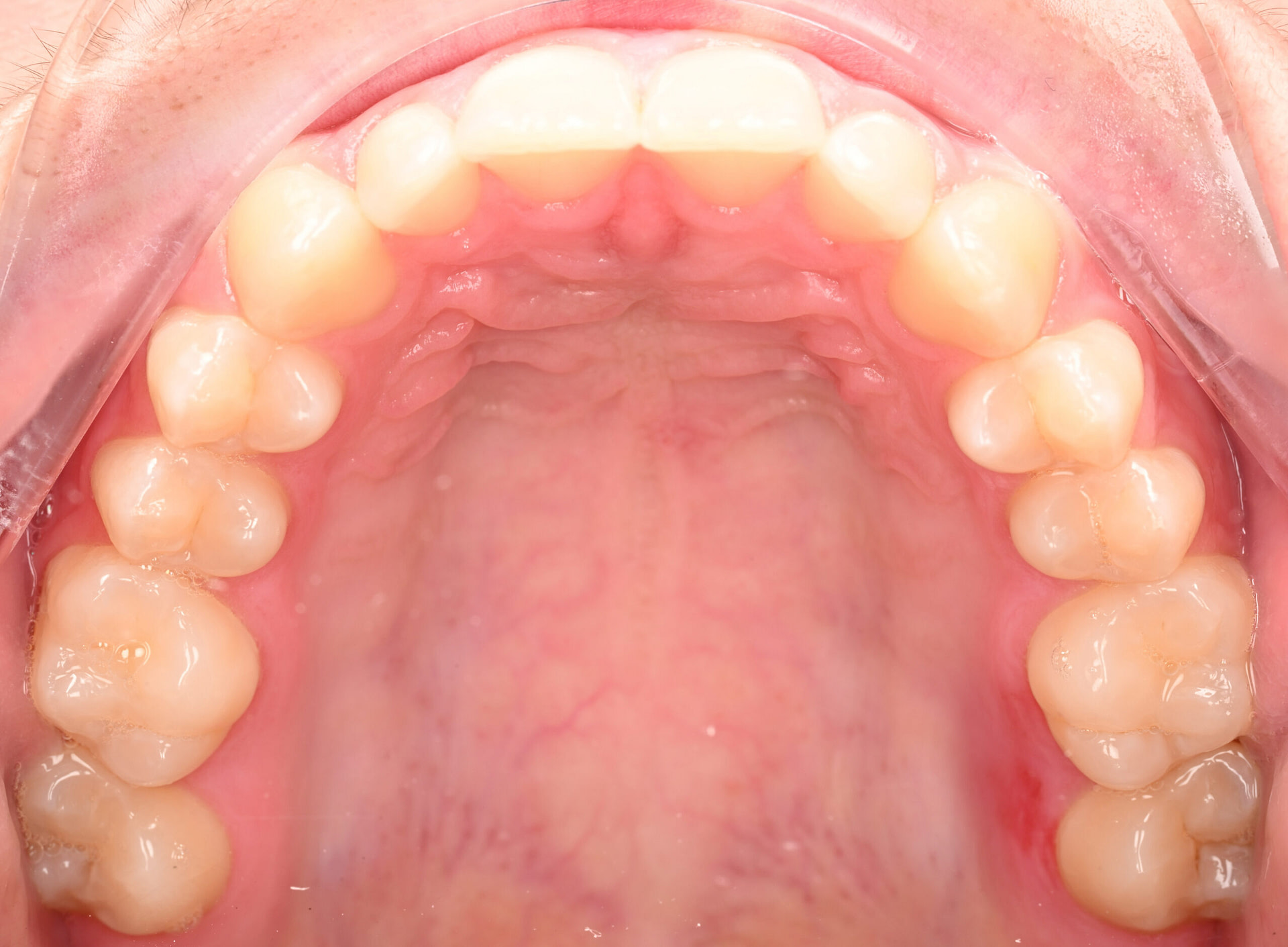 3shape-intraoral-trios-scan-bite-splint-idd-institute-of-digital-dentistry-blog-byron-park-patient-palatal-view