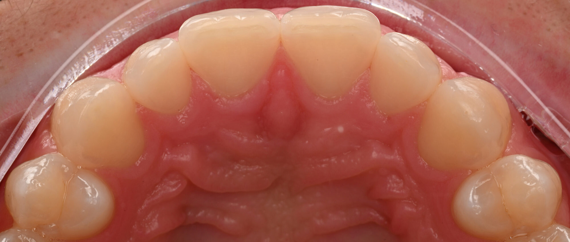 3shape-intraoral-trios-scan-bite-splint-idd-institute-of-digital-dentistry-blog-byron-park-patient-palatal-zoom-incisors
