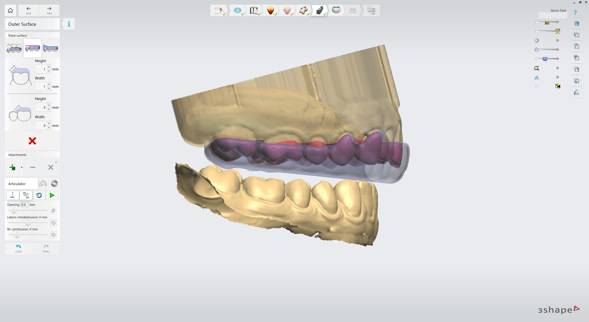 3shape-intraoral-trios-scan-bite-splint-idd-institute-of-digital-dentistry-blog-byron-park-splint-studio-flat-plane