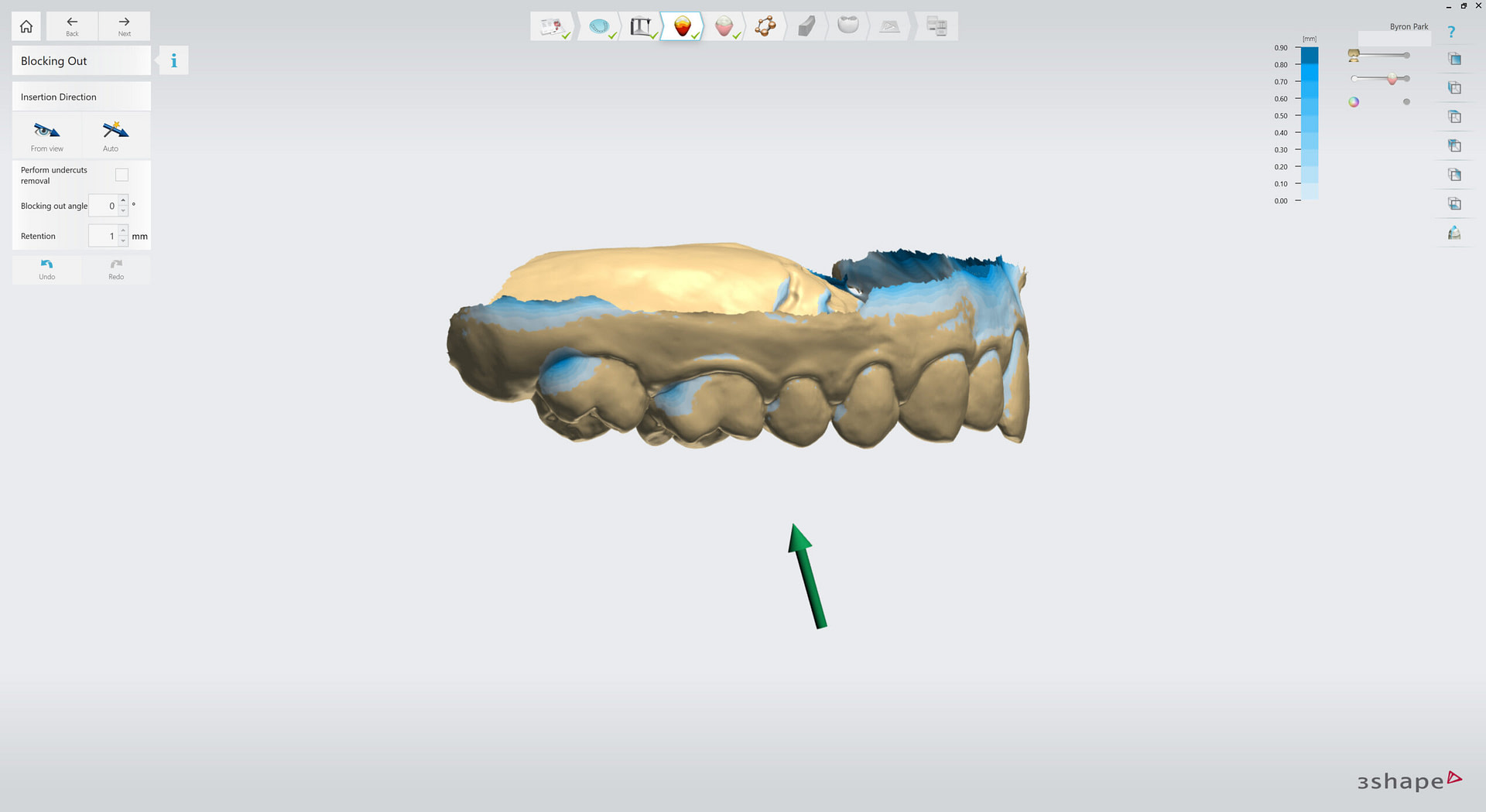 3shape-intraoral-trios-scan-bite-splint-idd-institute-of-digital-dentistry-blog-byron-park-splint-studio-insertion-direction