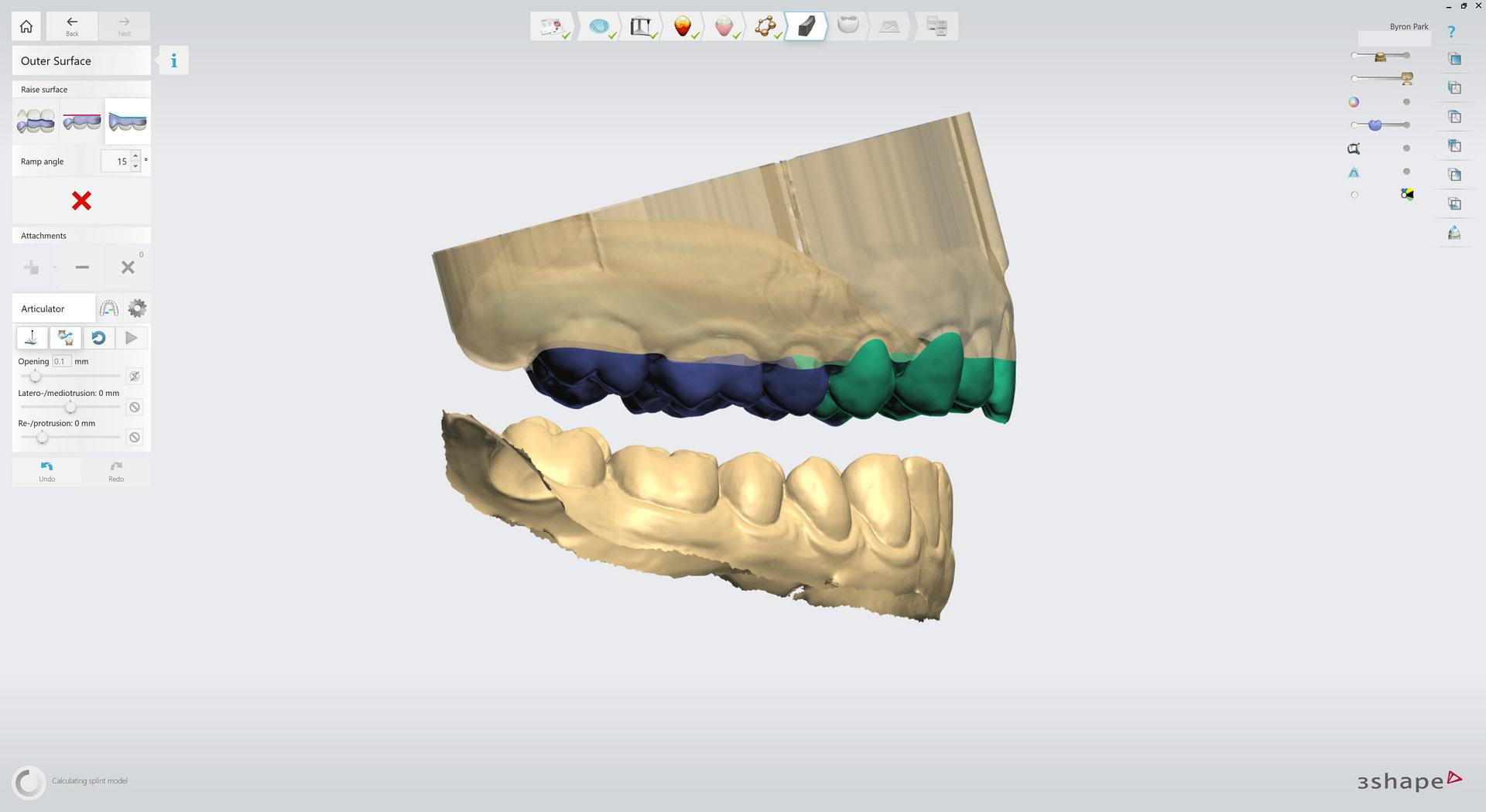 3shape-intraoral-trios-scan-bite-splint-idd-institute-of-digital-dentistry-blog-byron-park-splint-studio-outer-surface-splint