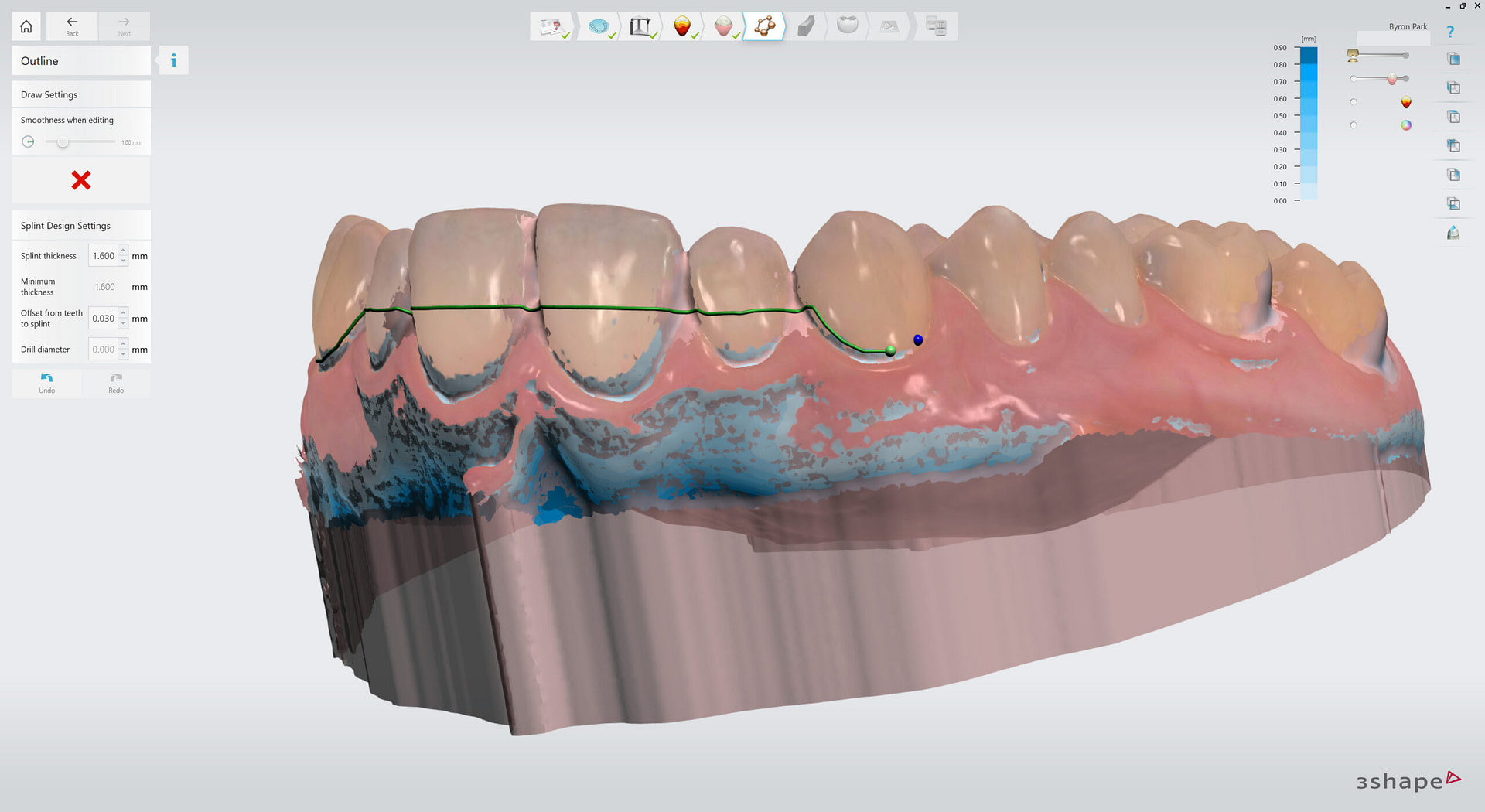 3shape-intraoral-trios-scan-bite-splint-idd-institute-of-digital-dentistry-blog-byron-park-splint-studio-outline-splint