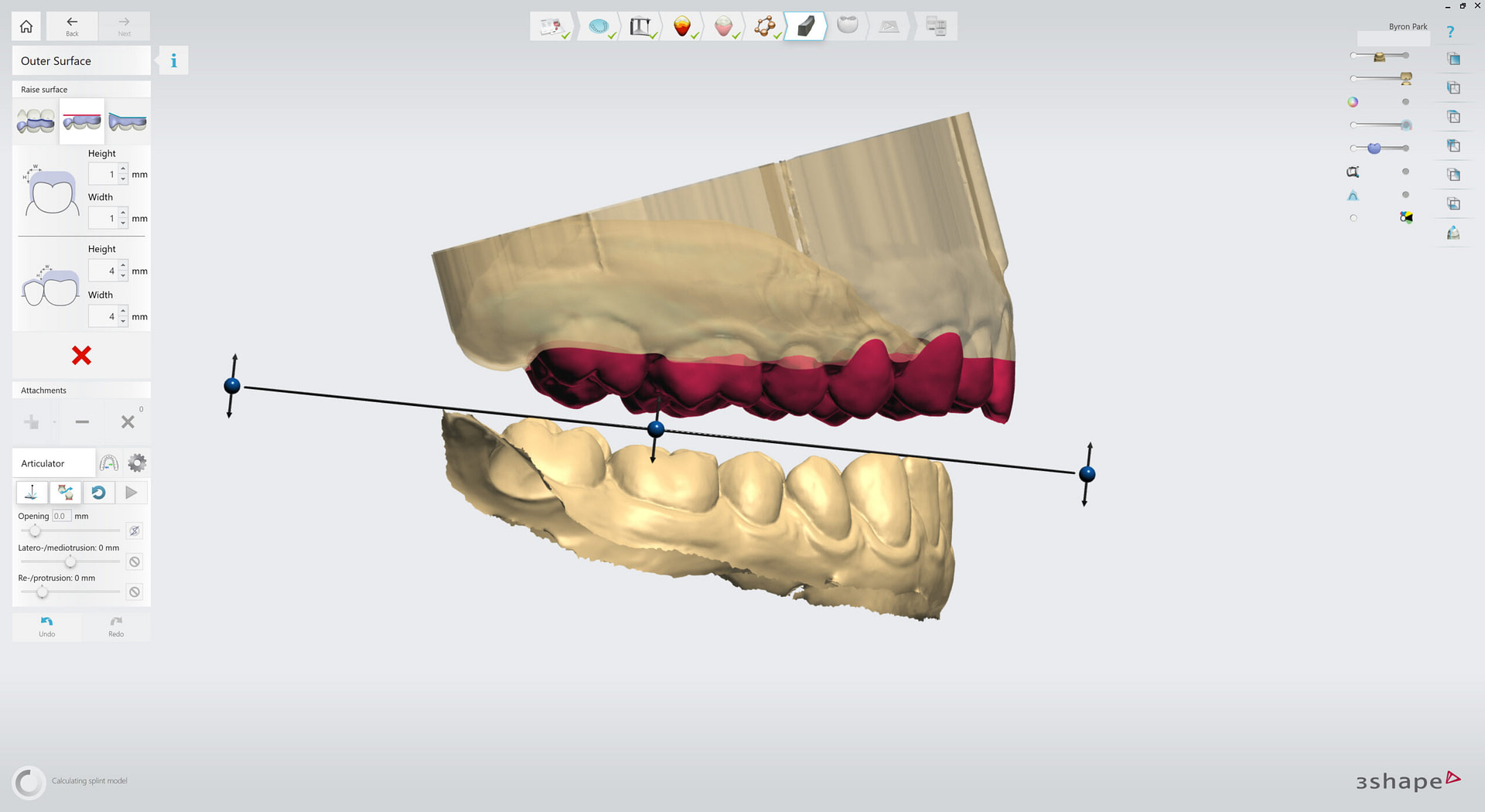 3shape-intraoral-trios-scan-bite-splint-idd-institute-of-digital-dentistry-blog-byron-park-splint-studio-raise-outer-surface