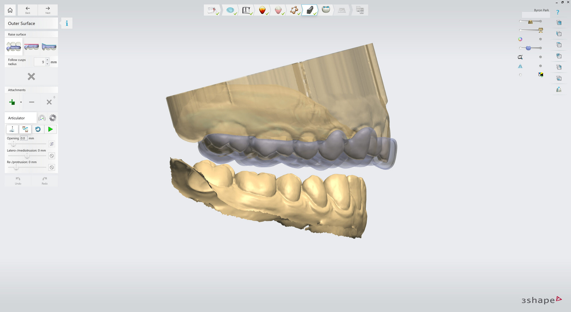 3shape-intraoral-trios-scan-bite-splint-idd-institute-of-digital-dentistry-blog-byron-park-splint-studio-splint-uniform-thickness