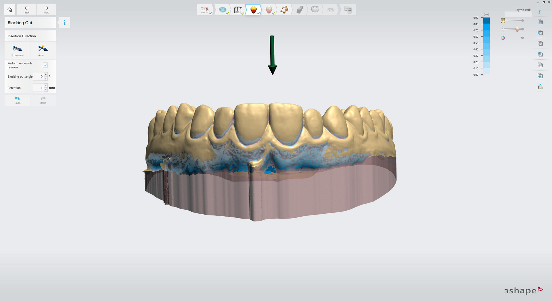 3shape-intraoral-trios-scan-bite-splint-idd-institute-of-digital-dentistry-blog-byron-park-splint-studio-undercut-removal-block-model