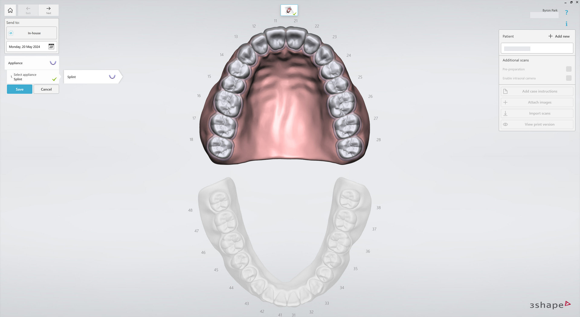 3shape-intraoral-trios-scan-bite-splint-idd-institute-of-digital-dentistry-blog-byron-park-splint-studio-upper-jaw
