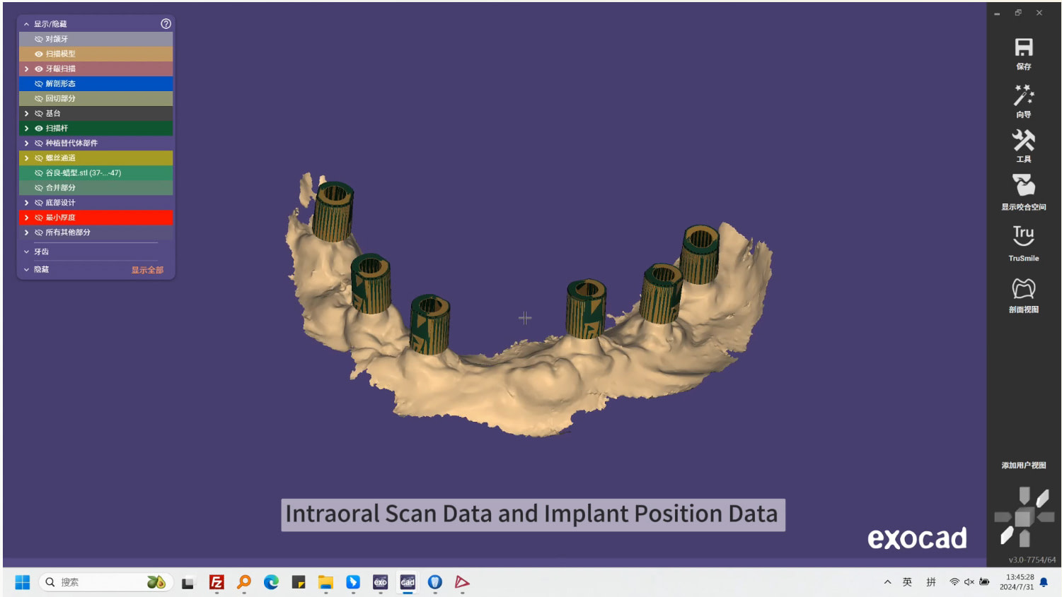 shining-3d-dental-aoralscan-elite-intraoral-scanner-launch-idd-institute-of-digital-dentistry-blog-provisional-design