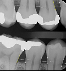 bone-measurement-white-line-yellow-line-pearl-ai-second-opinion-idd-institute-of-digital-dentistry-blog