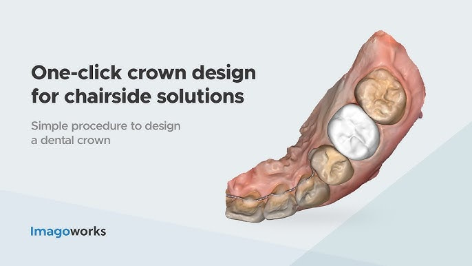 imagoworks-dentbird-ai-one-click-crown-design-web-dental-cad-3dme-idd-institute-of-digital-dentistry-podcast-blog