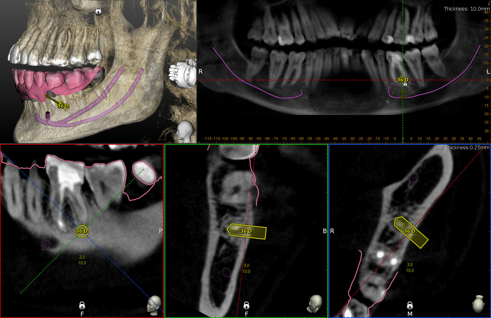navident-evo-claronav-dynamic-navigation-idd-institute-of-digital-dentistry-dr-byron-park-first-impressions-aligned-cbct-intraoral-scans