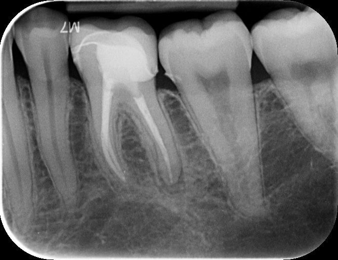 navident-evo-claronav-dynamic-navigation-idd-institute-of-digital-dentistry-dr-byron-park-first-impressions-pre-op-pa-scan