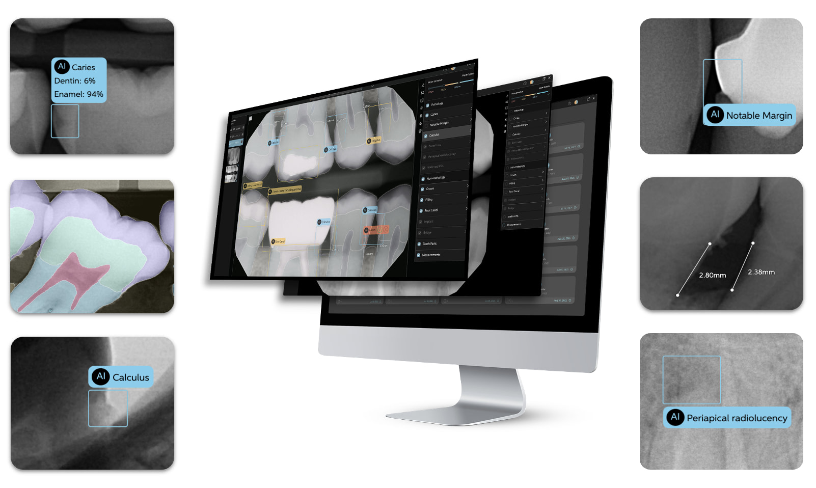 periapical-radiolucencies-notable-margins-calculus-caries-bone-measurement-pearl-ai-second-opinion-idd-institute-of-digital-dentistry-blog