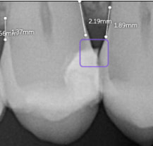 purple-square-notable-margins-pearl-ai-second-opinion-idd-institute-of-digital-dentistry-blog