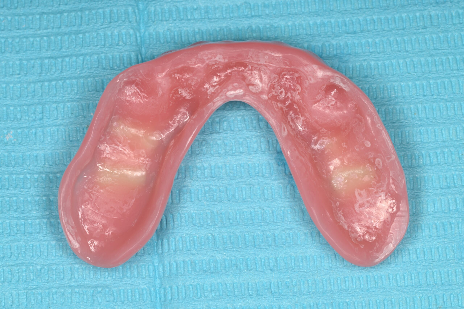 rodin-soft-reline-kit-3d-printed-dentures-workflow-blog-idd-institute-of-digital-dentistry-lower-denture-adhesive-primer-intaglio-surface-application