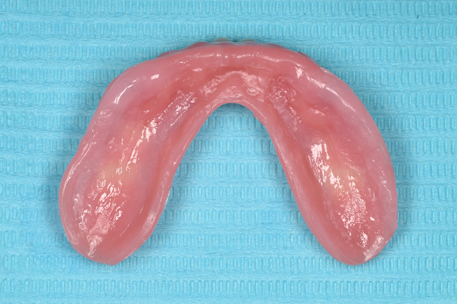 rodin-soft-reline-kit-3d-printed-dentures-workflow-blog-idd-institute-of-digital-dentistry-lower-denture-soft-reline-material-intaglio-surface-application